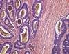Increased adenoma detection rate associated with lower risk of colorectal cancer and death Increased adenoma detection rate associated with lower risk of colorectal cancer and death