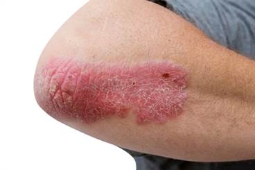 Dalazatide effective for skin lesions in plaque psoriasis Dalazatide effective for skin lesions in plaque psoriasis