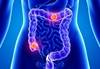 Colorectal cancer mortality rates increasing in younger white adults Colorectal cancer mortality rates increasing in younger white adults