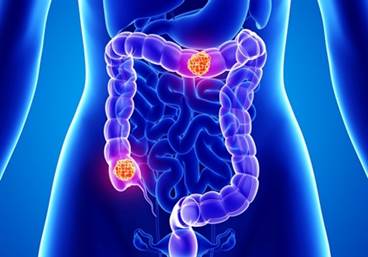 Colorectal cancer mortality rates increasing in younger white adults Colorectal cancer mortality rates increasing in younger white adults