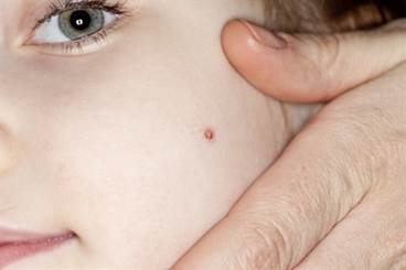 Oral isotretinoin better than topical treatment for warts Oral isotretinoin better than topical treatment for warts