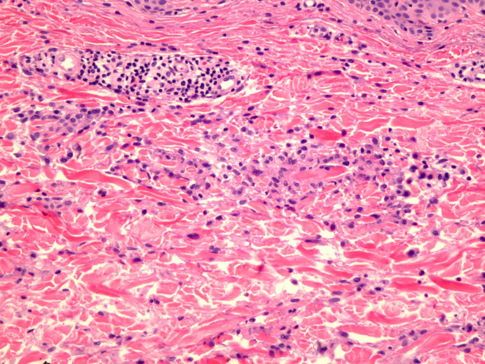 Interstitial Granulomatous Dermatitis Interstitial Granulomatous