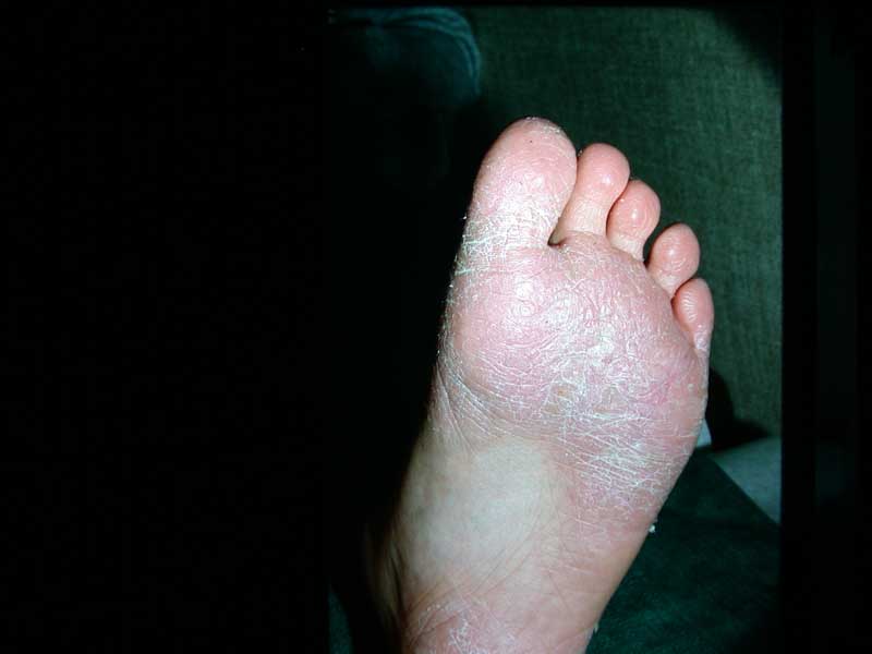 Juvenile Plantar Dermatosis (atopic Winter Feet, Forefoot Dermatosis ...