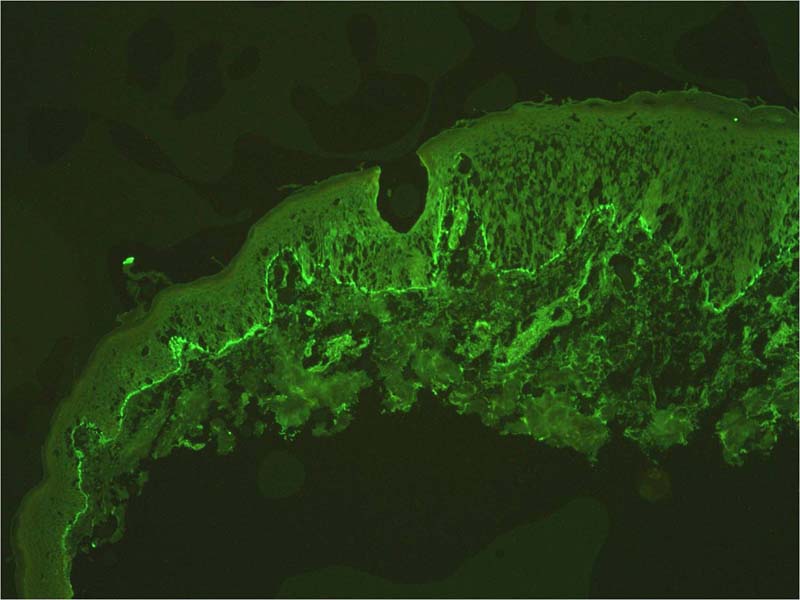 Linear IgA Dermatosis and Chronic Bullous Dermatosis of Childhood