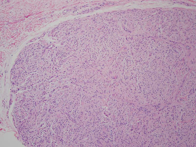 Palisaded Encapsulated Neuroma (Neuroma [PEN and traumatic], Solitary