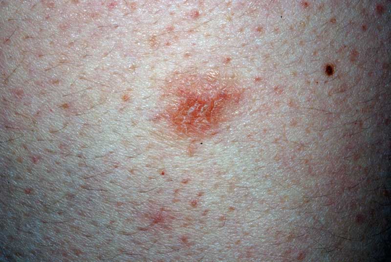 Nummular dermatitis (nummular eczema) The Clinical Advisor