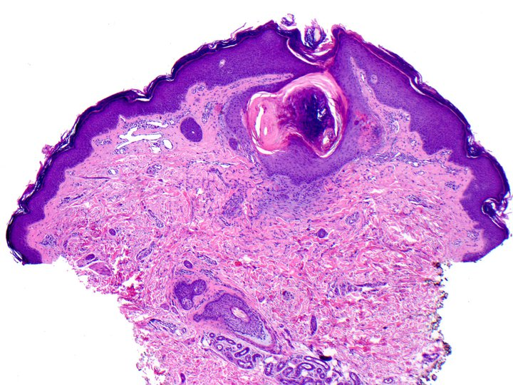 Phrynoderma The Clinical Advisor