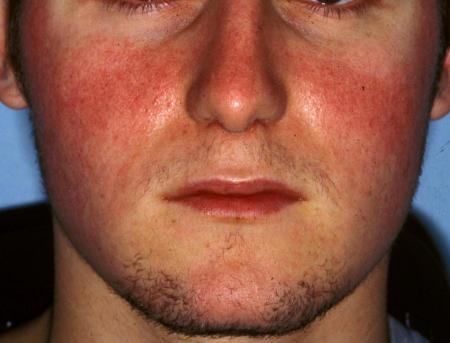 For facial edema burning eyes All facial edema burning eyes Such