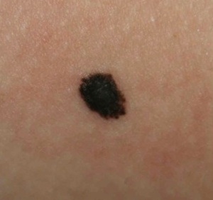 Spitz Nevus - The Clinical Advisor