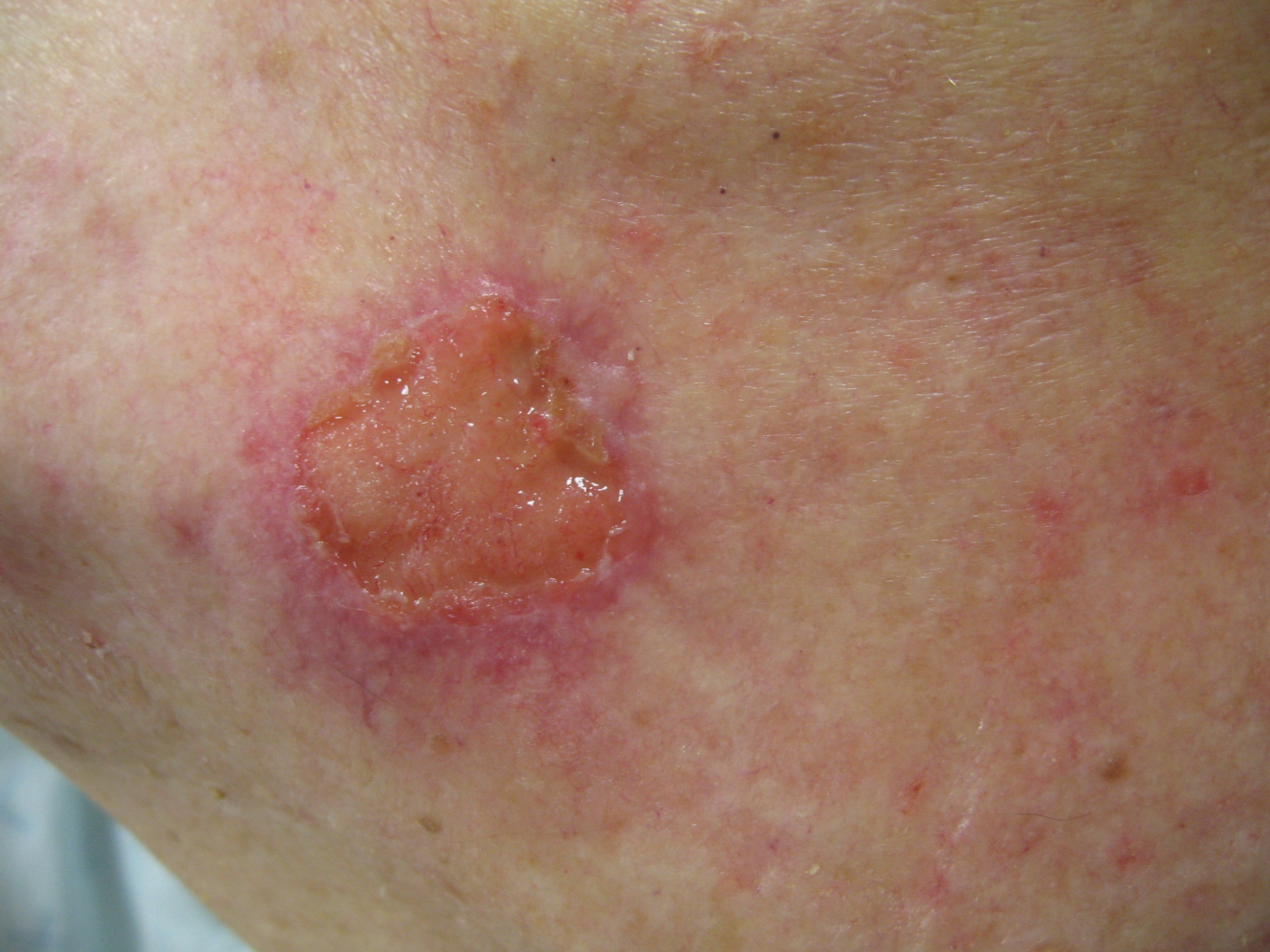 Squamous Cell Carcinoma Of The Skin The Clinical Advisor