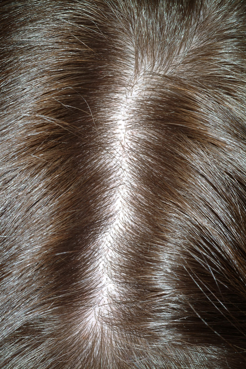 Telogen Effluvium (StressInduced Alopecia) The Clinical