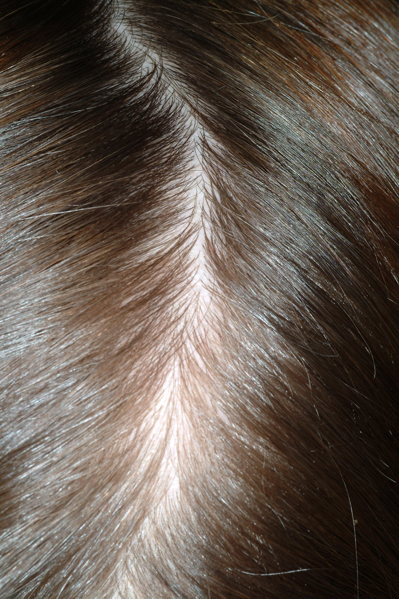 telogen-effluvium-stress-induced-alopecia-the-clinical-advisor