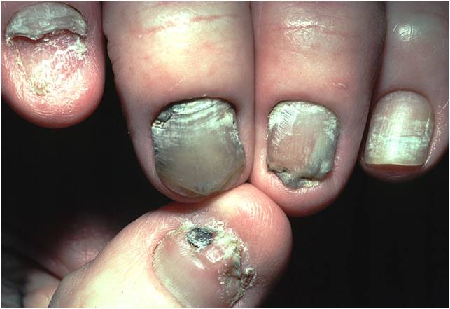 yellow-nail-syndrome-the-clinical-advisor