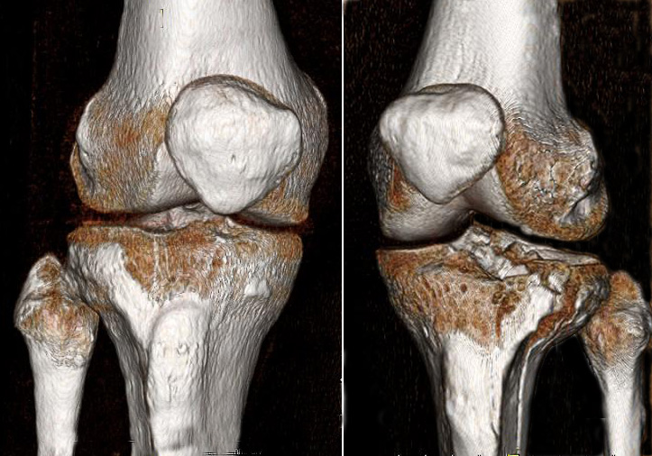 Open reduction internal fixation (ORIF) of tibial plateau fracture
