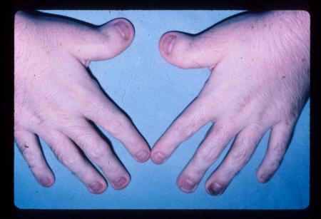 Rubinstein - Taybi Syndrome (Rubinstein syndrome, broad thumb-hallux