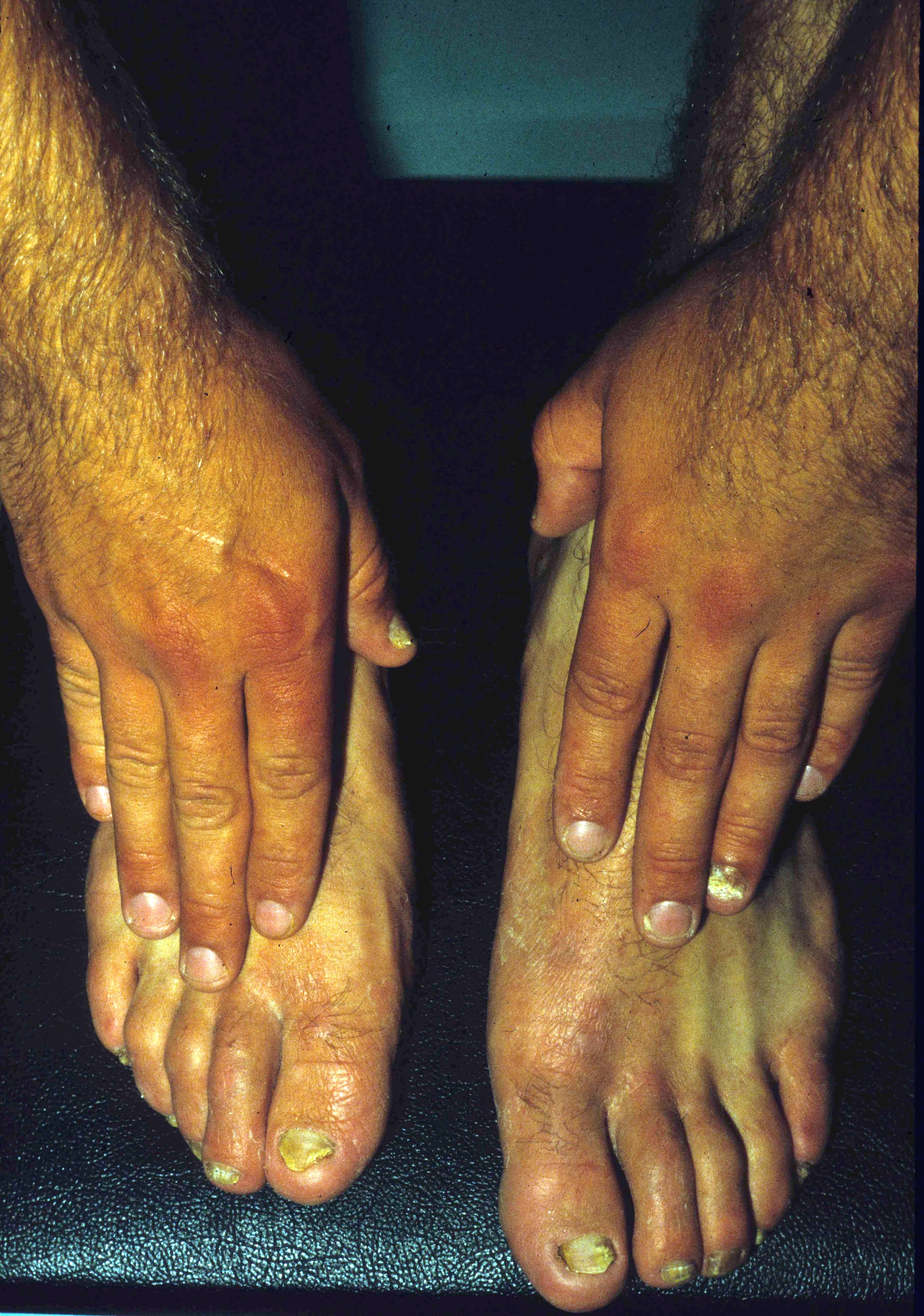 Superficial Mycoses Dermatophytosis The Clinical Advisor