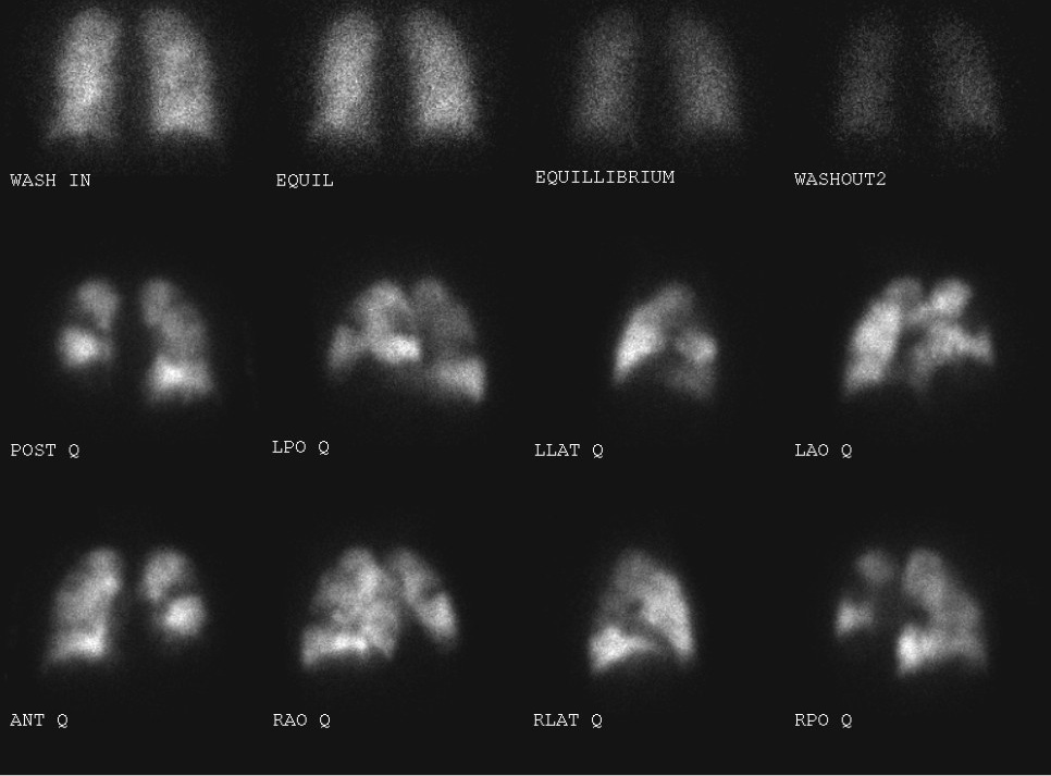 Chronic Thromboembolic Pulmonary Hypertension The Clinical Advisor