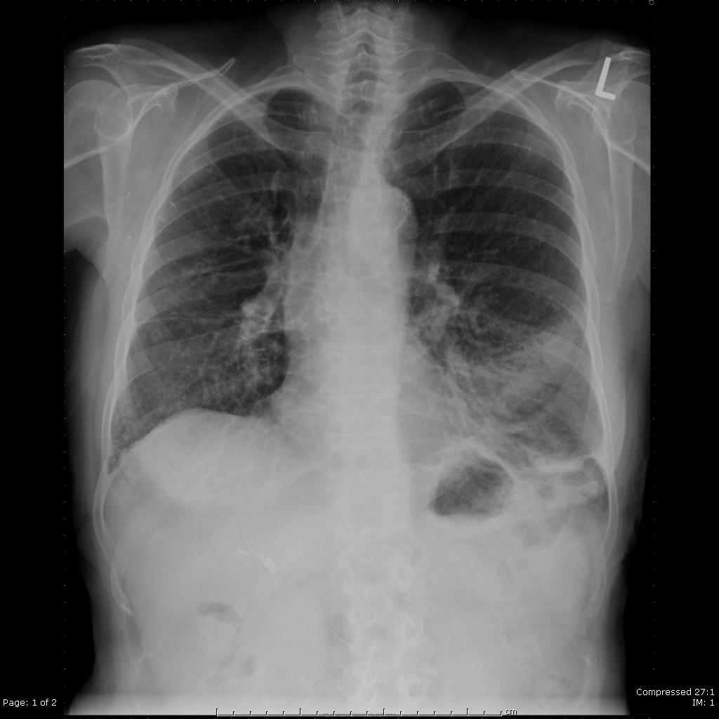 Radiation Induced Lung Injury The Clinical Advisor