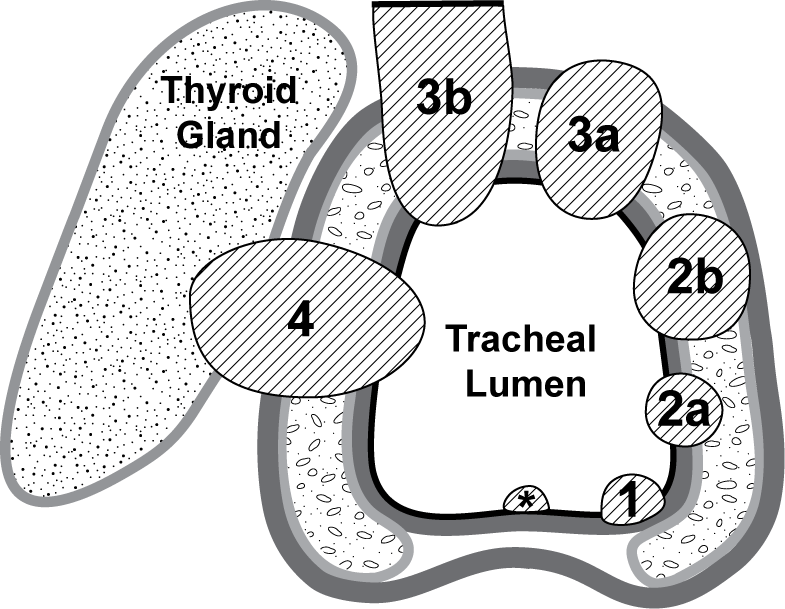 Tracheal Tumors The Clinical Advisor