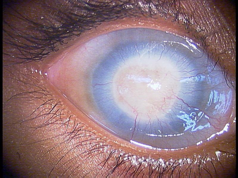 corneal-opacity-the-clinical-advisor