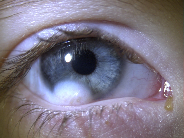 corneal-opacity-can-be-reason-for-vision-loss-blog-bharti-eye