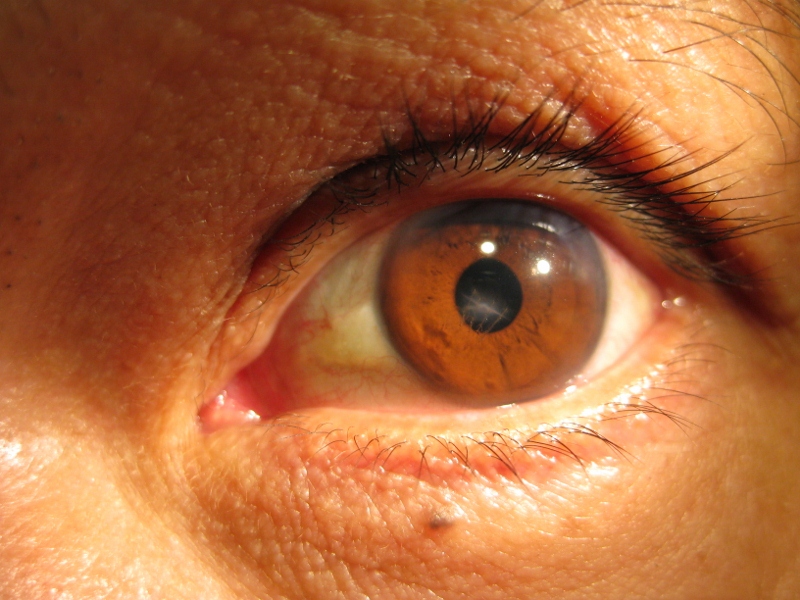 corneal-opacity-the-clinical-advisor