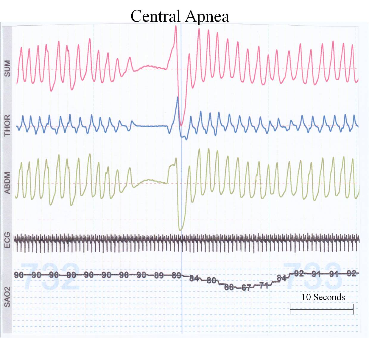 apnea-of-prematurity-the-clinical-advisor