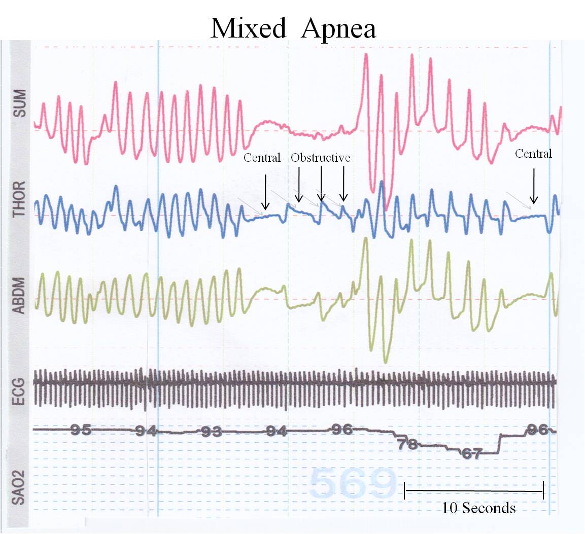 toddler pauses breathing while awake