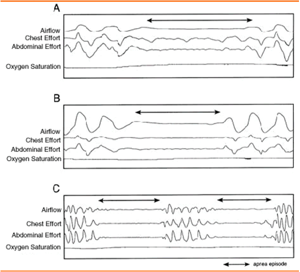 Obstructive sleep apnea The Clinical Advisor