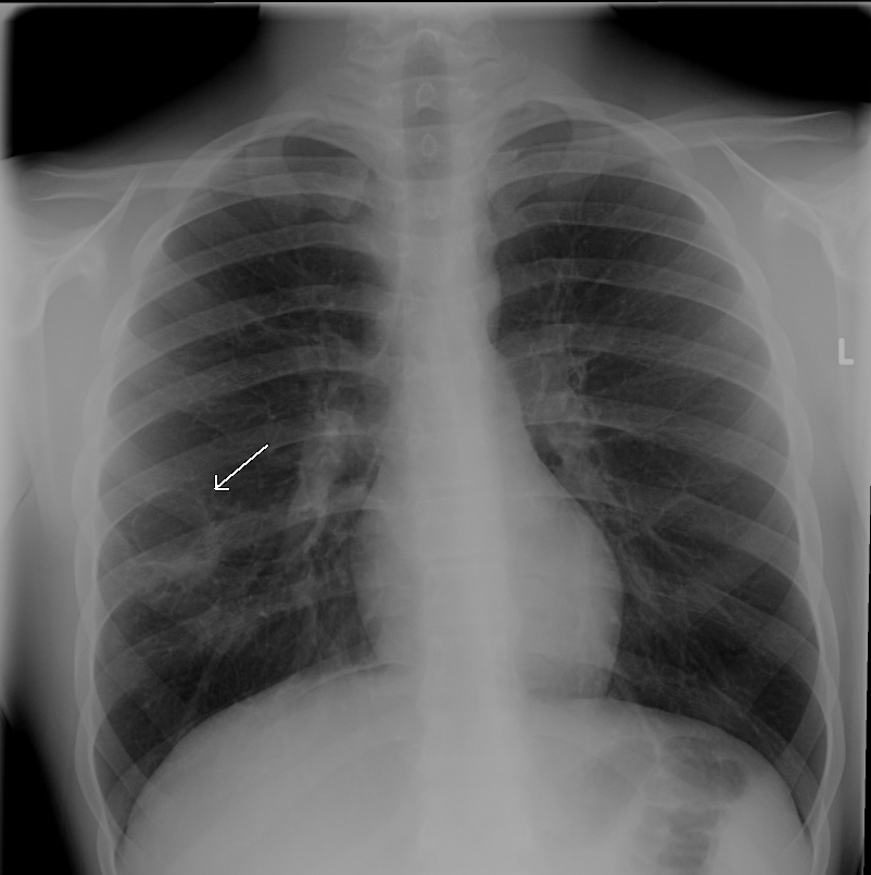 Pulmonary nodules The Clinical Advisor