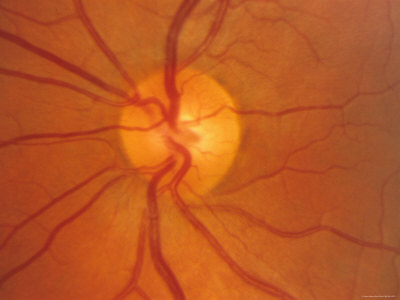 Increased intracranial pressure - The Clinical Advisor