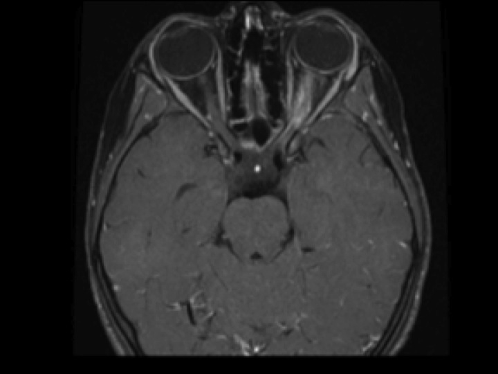 multiple-sclerosis-the-clinical-advisor