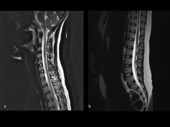 21+ Multiple Sclerosis Ct Scan Pictures