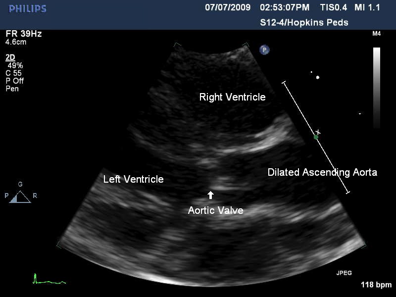 aortic-stenosis-the-clinical-advisor