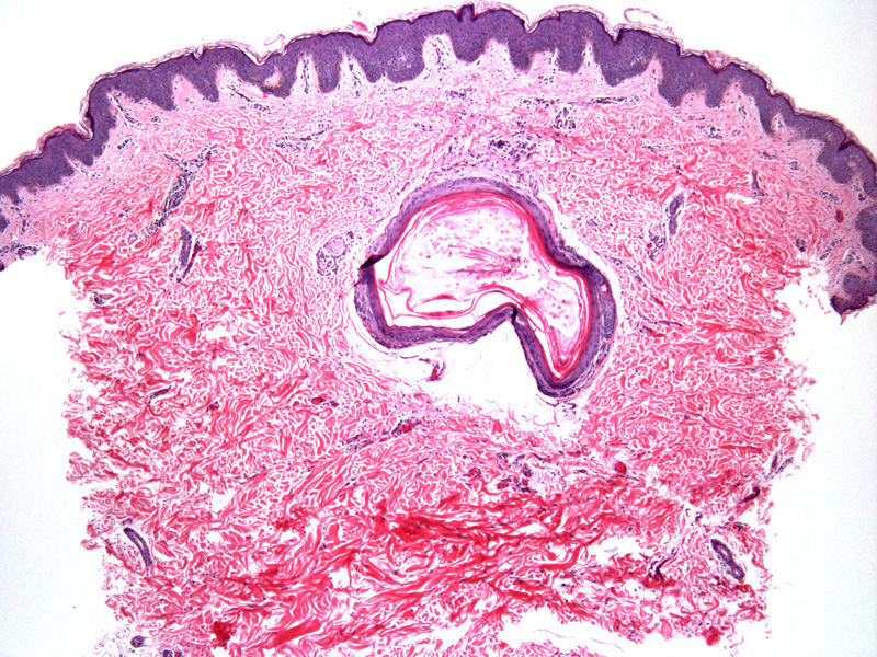 Eruptive Vellus Hair Cyst The Clinical Advisor