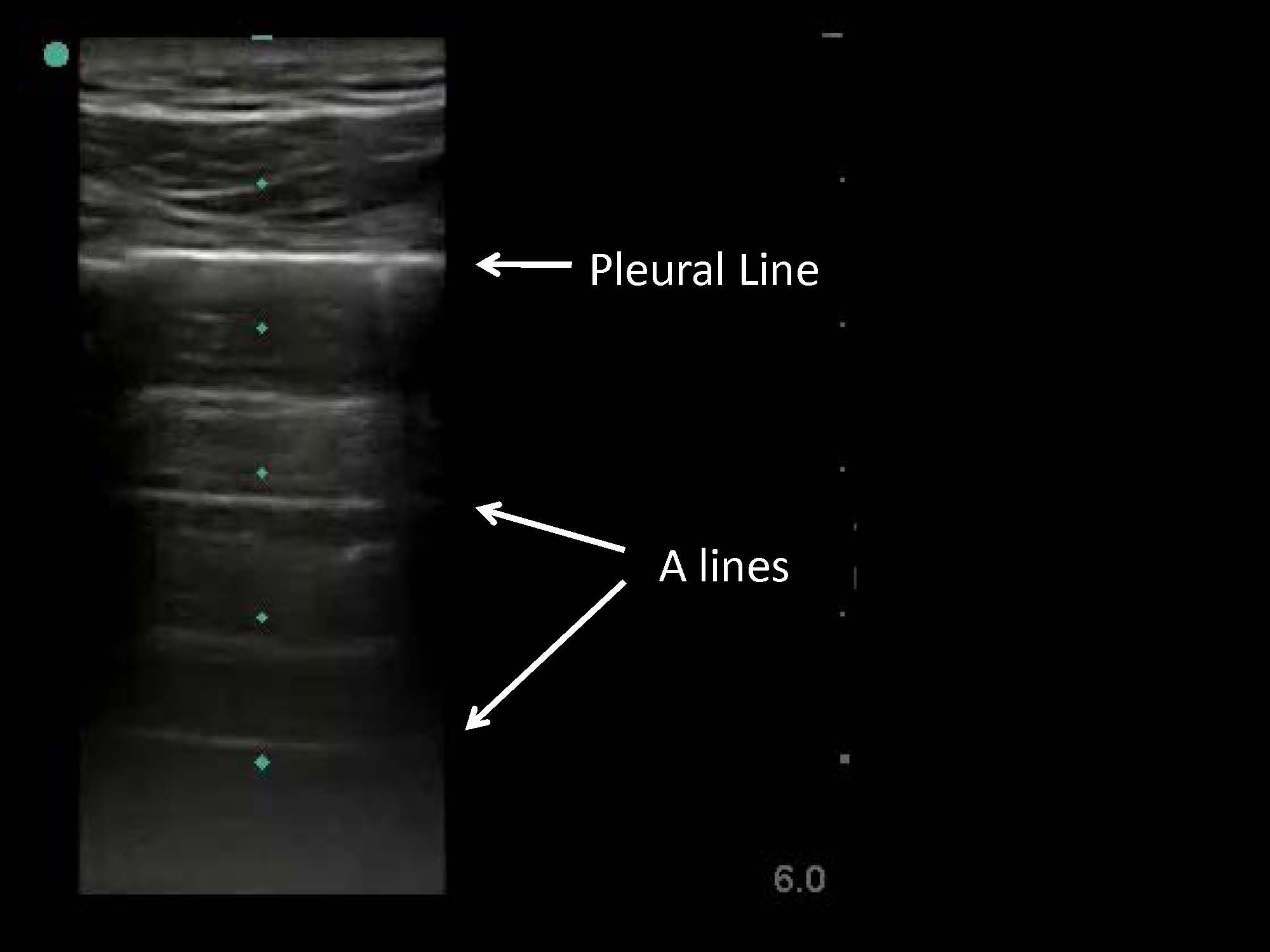 Thoracentesis, Pleural Biopsy, And Thoracic Ultrasound - The Clinical ...