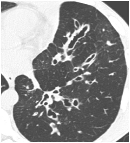Bronchiectasis The Clinical Advisor