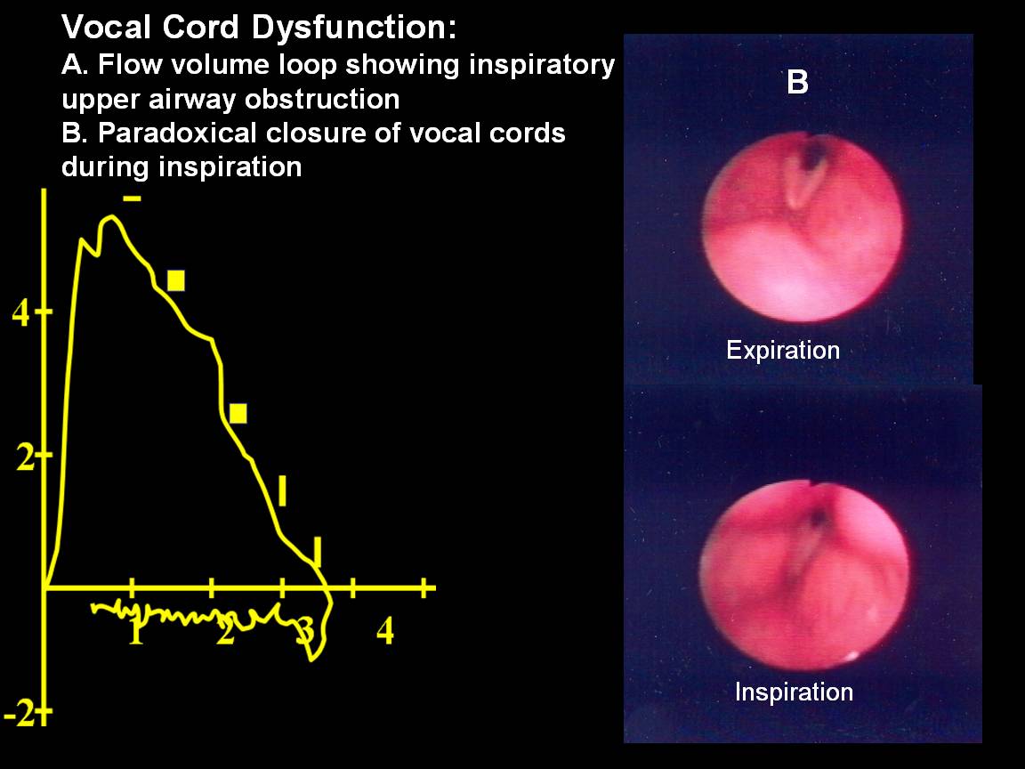 Disorders of the Central Airways and Upper Airway Obstruction The