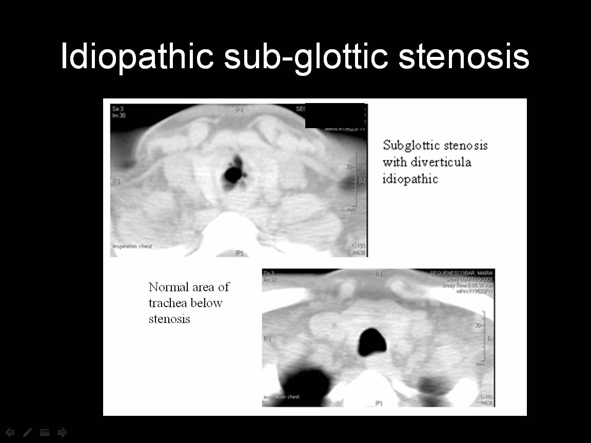 Disorders of the Central Airways and Upper Airway Obstruction - The