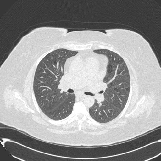 bronchiolitis-respiratory-bronchiolitis-acute-bronchiolitis