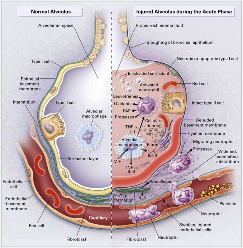 pulmonary edema