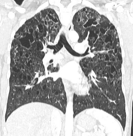 Pulmonary Langerhans Cell Histiocytosis - The Clinical Advisor