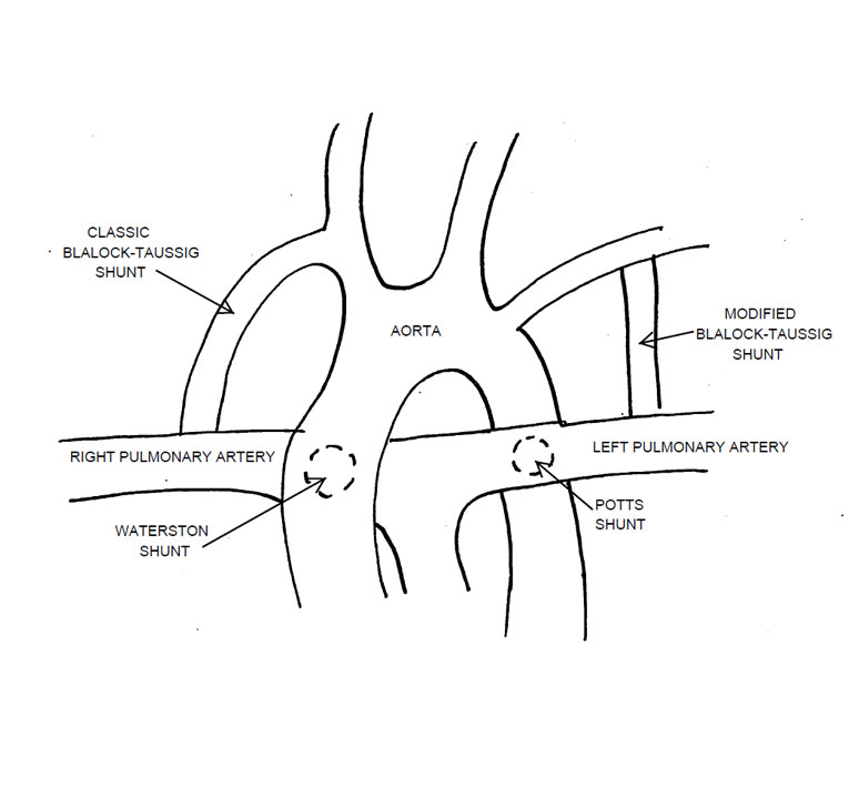 Tetralogy Of Fallot - The Clinical Advisor