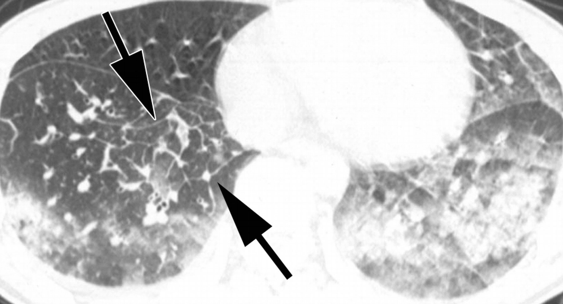 acute-eosinophilic-pneumonia-the-clinical-advisor