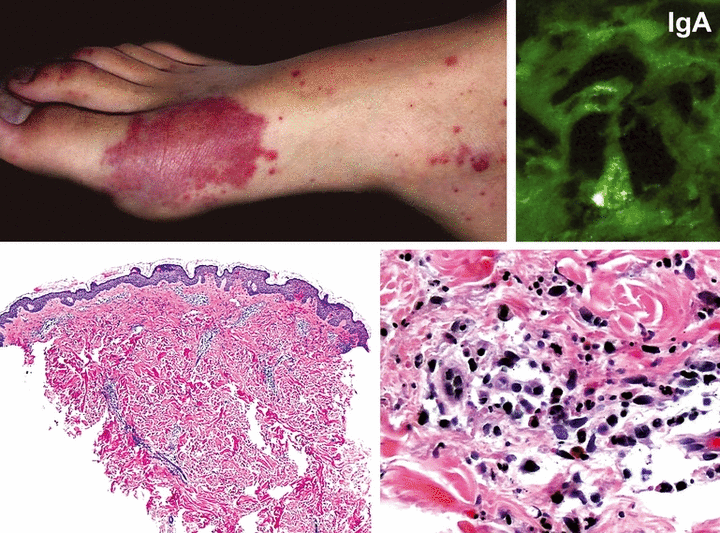 Henoch Schönlein purpura IgA Vasculitis The Clinical Advisor