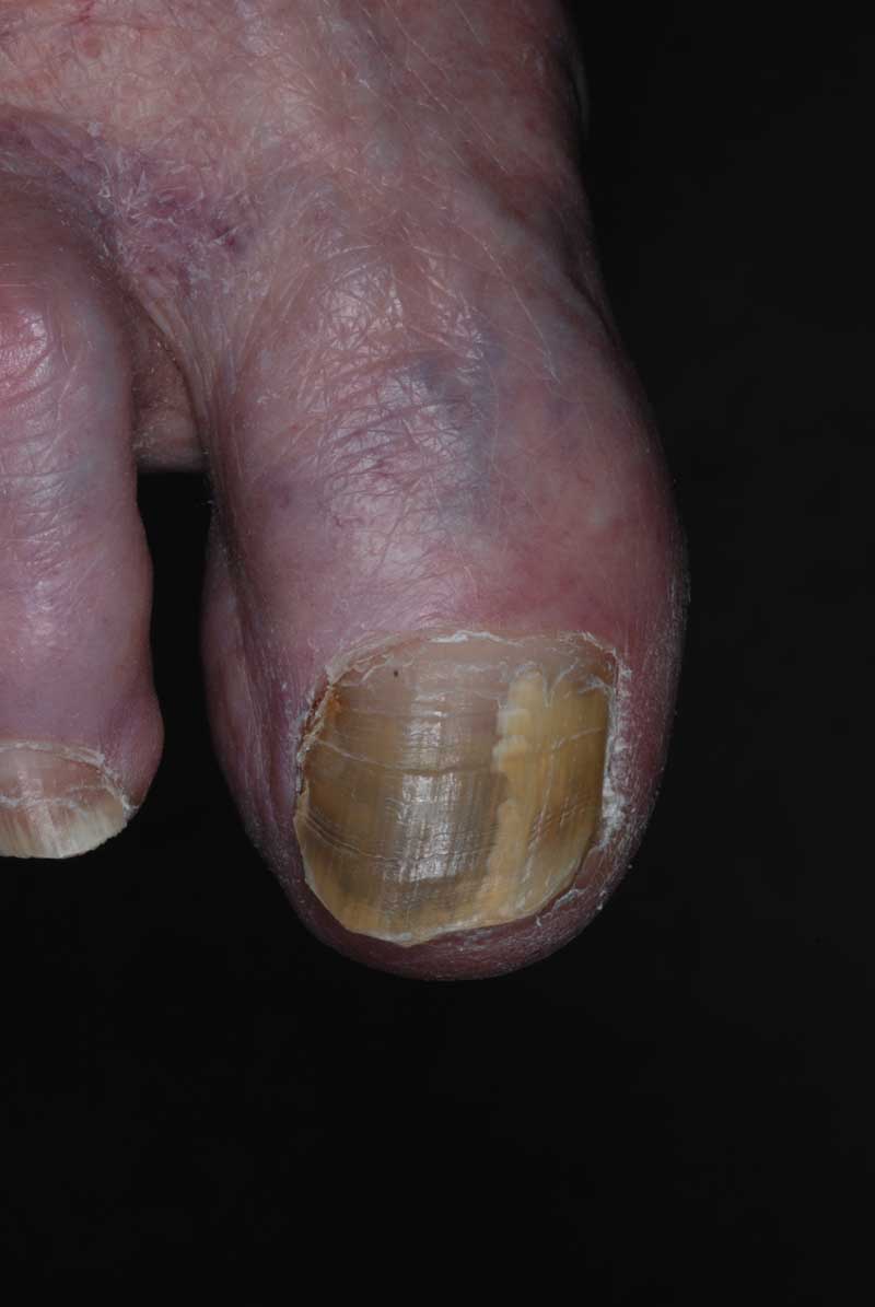 Ciprofloxacin pseudomonas infection of the nail Ciprofloxacin pseudomonas infection of the nail