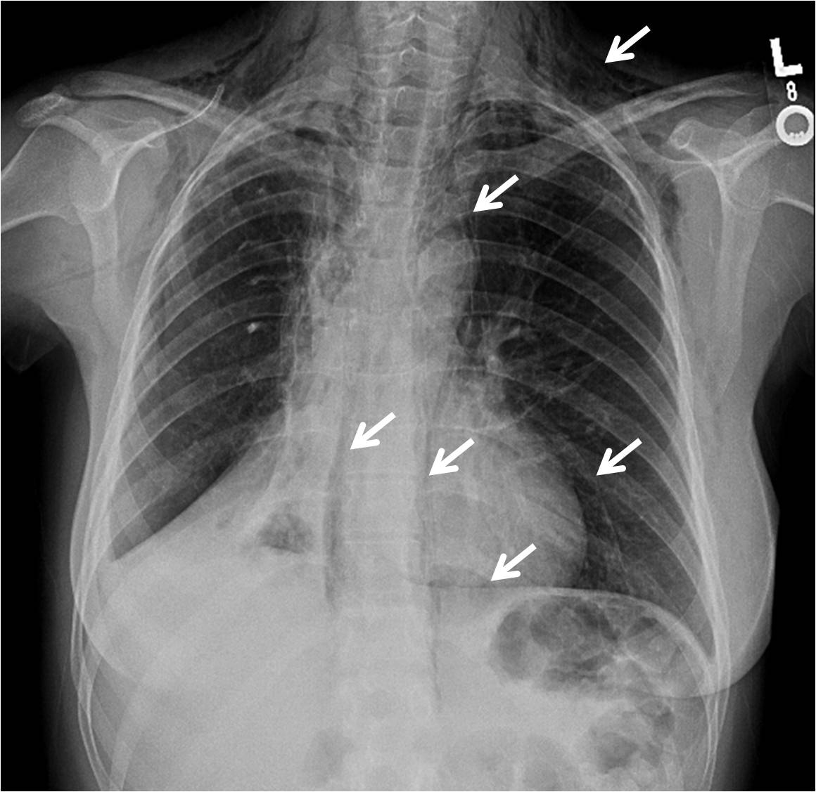 non-neoplastic-disorders-of-the-mediastinum-pneumomediastinum-the