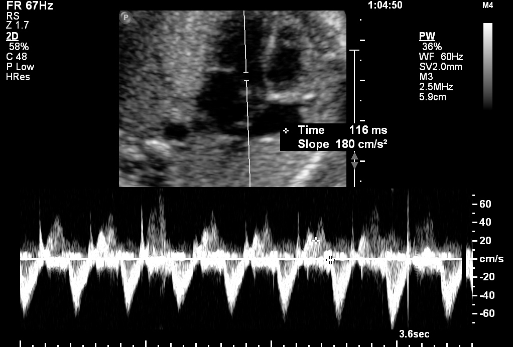 Fetal bradycardia - The Clinical Advisor