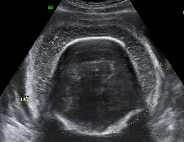 fetal-hydrops-the-clinical-advisor