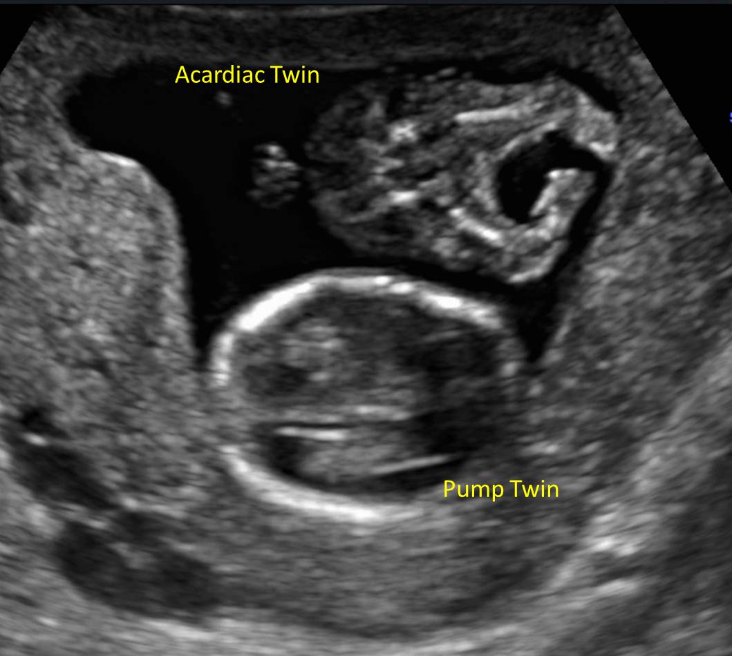 TRAP Syndrome The Clinical Advisor